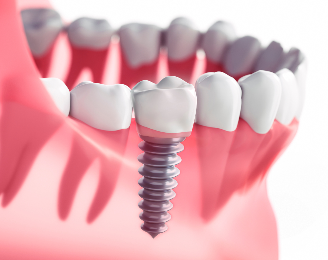 Implantes Dentários em Niterói 1 3 e1749104787547
