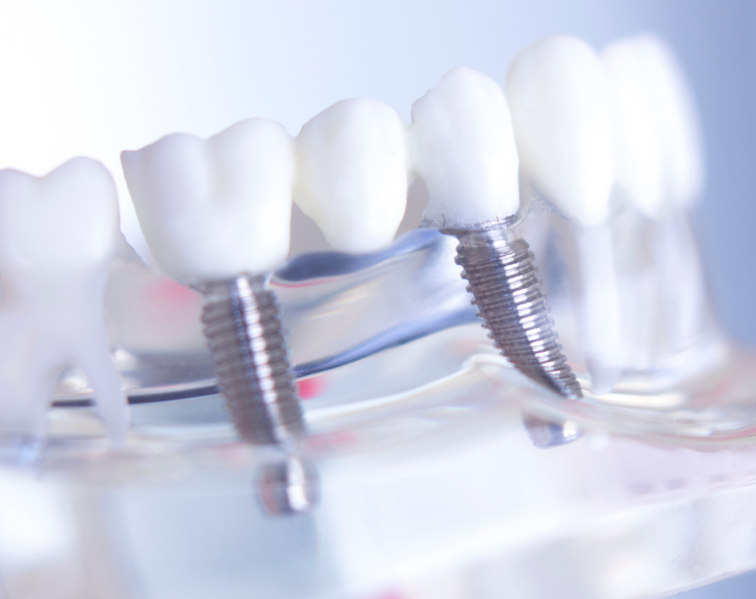 Implantes Dentários em Niterói 2 4 e1749104832744