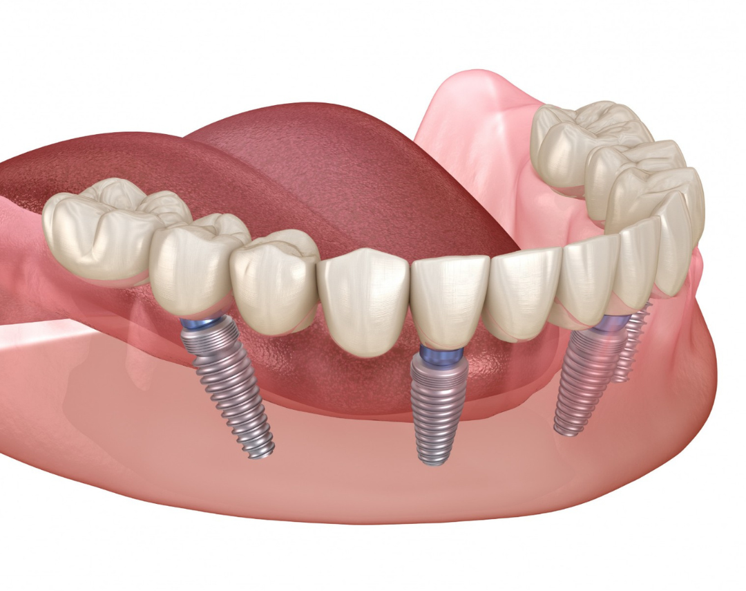 Implantes Dentários em Niterói 3 5 e1749104741686
