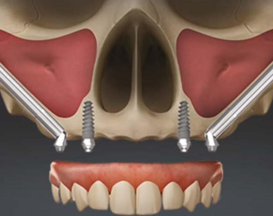 Implantes Dentários em Niterói 4 6 e1749104705664