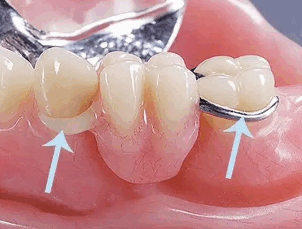 Implantes Dentários em Niterói 7 7 e1749106369221