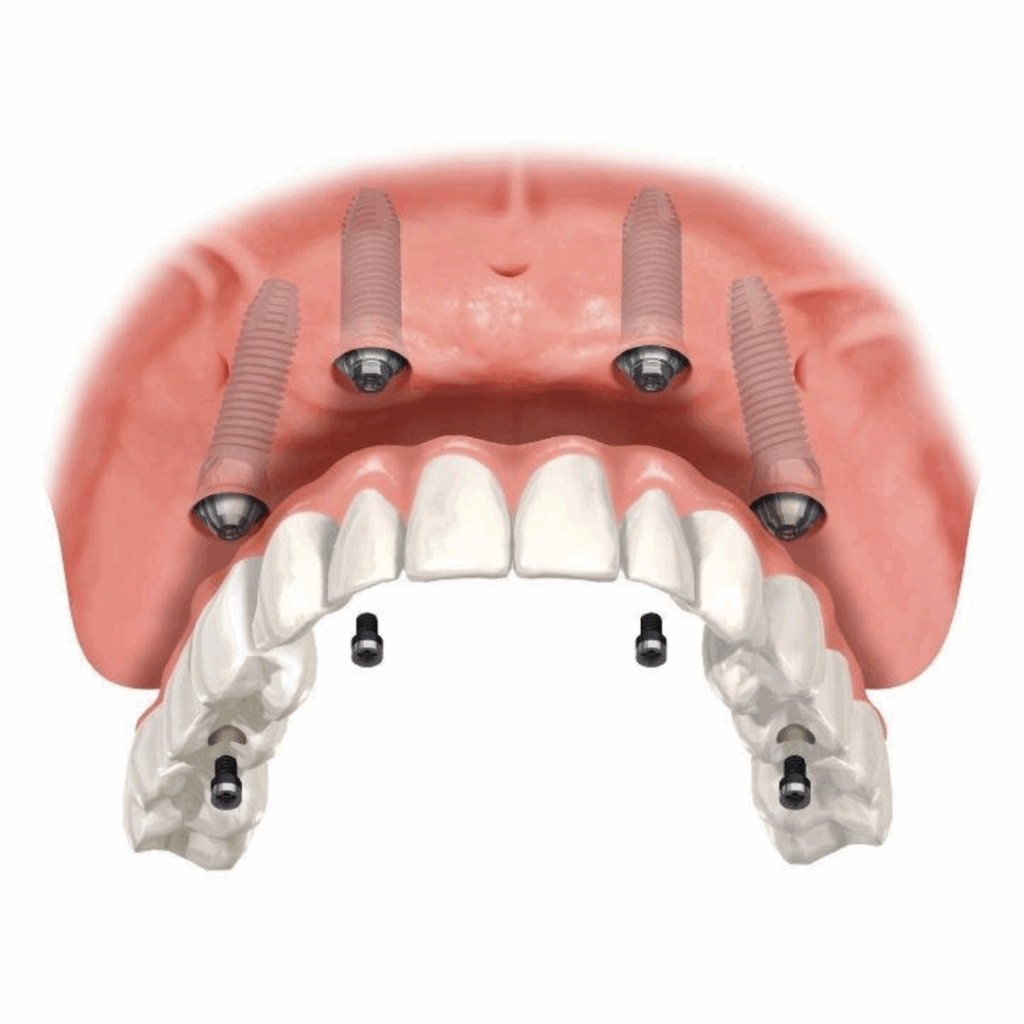 Implantes Dentários em Niterói 6 9